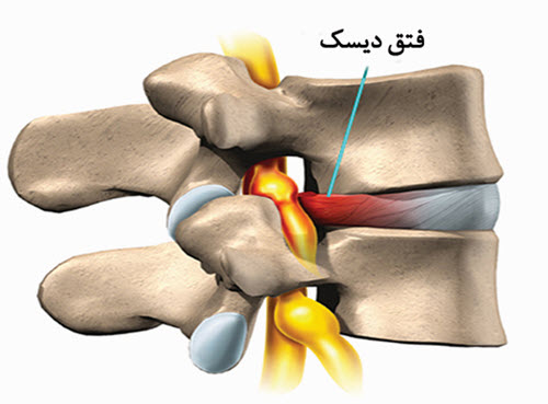 دیسك ستون فقرات
